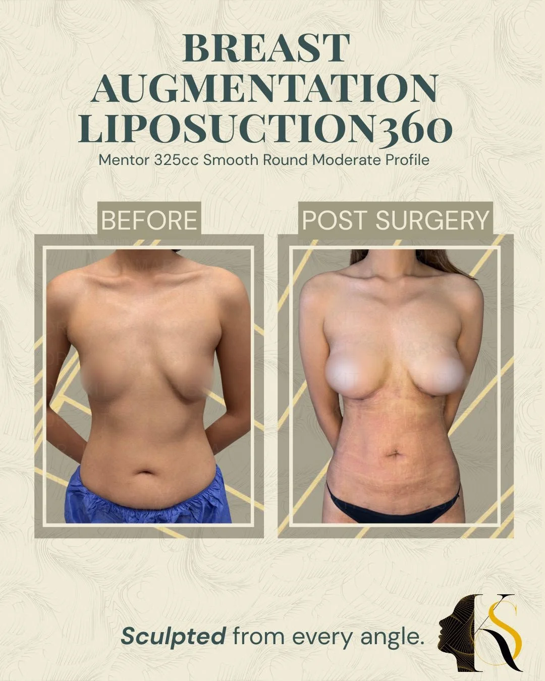 Transforming more than volume&mdash;creating balance, proportion, and confidence.

Beautiful results come from treating the body as a whole. By combining 325cc Mentor Smooth Round Moderate Profile implants with Lipo360, we enhanced both the breasts a