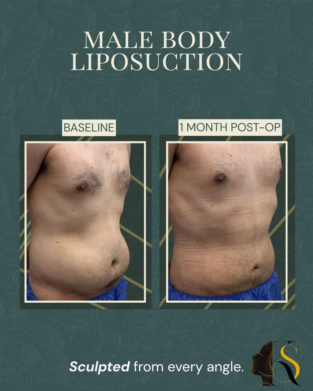 Male Body Liposuction: Designed to enhance masculine contours&mdash;not change who you are.

At just 1 month post-op, swelling is still present, yet the improvement is already noticeable. The abdomen is flatter, the waist is slimmer, and the overall 