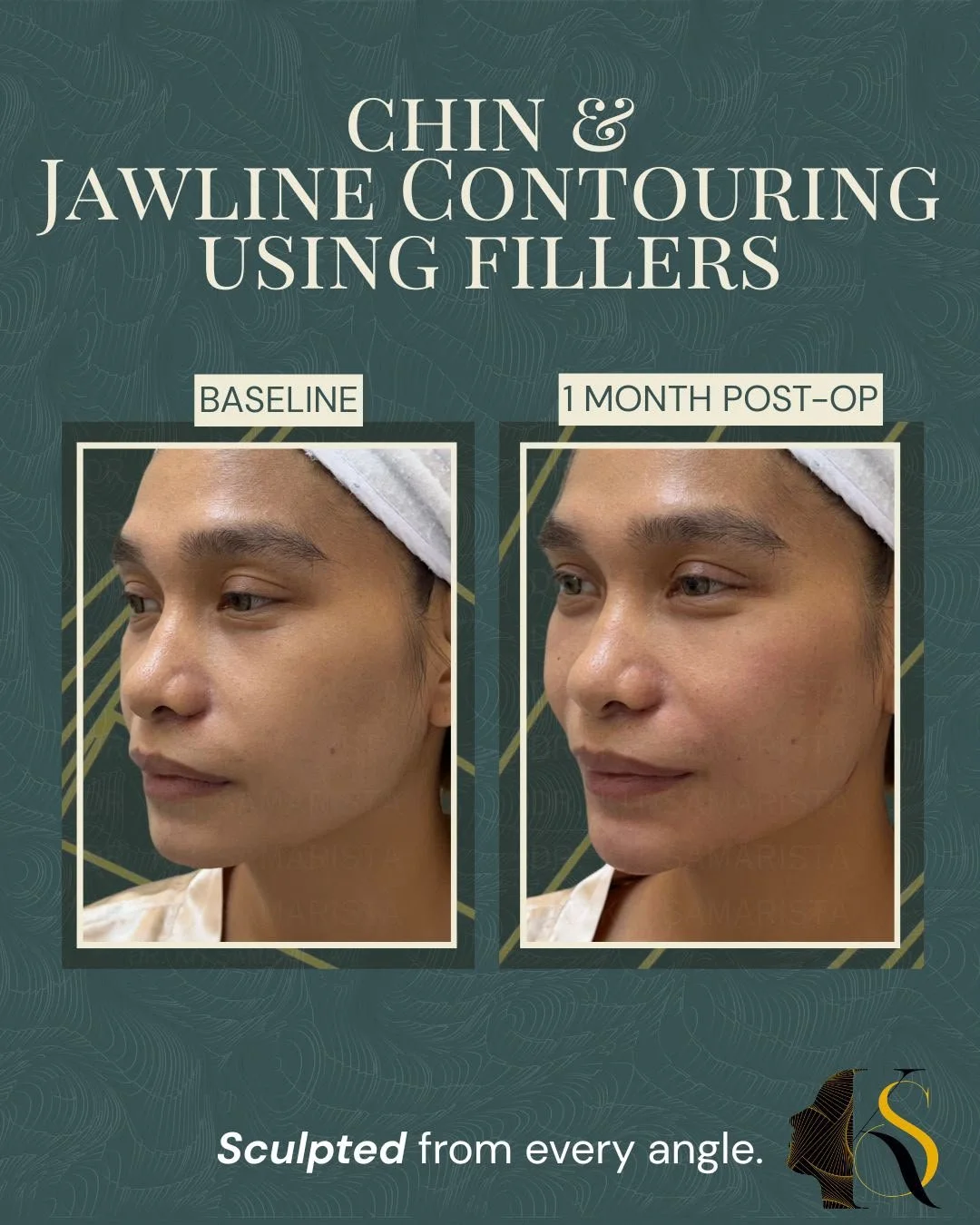 A stronger profile. A more defined you.

Sometimes, subtle changes create the biggest impact. With strategic placement of dermal fillers, we enhanced the chin projection and jawline definition while maintaining the patient&rsquo;s natural facial prop