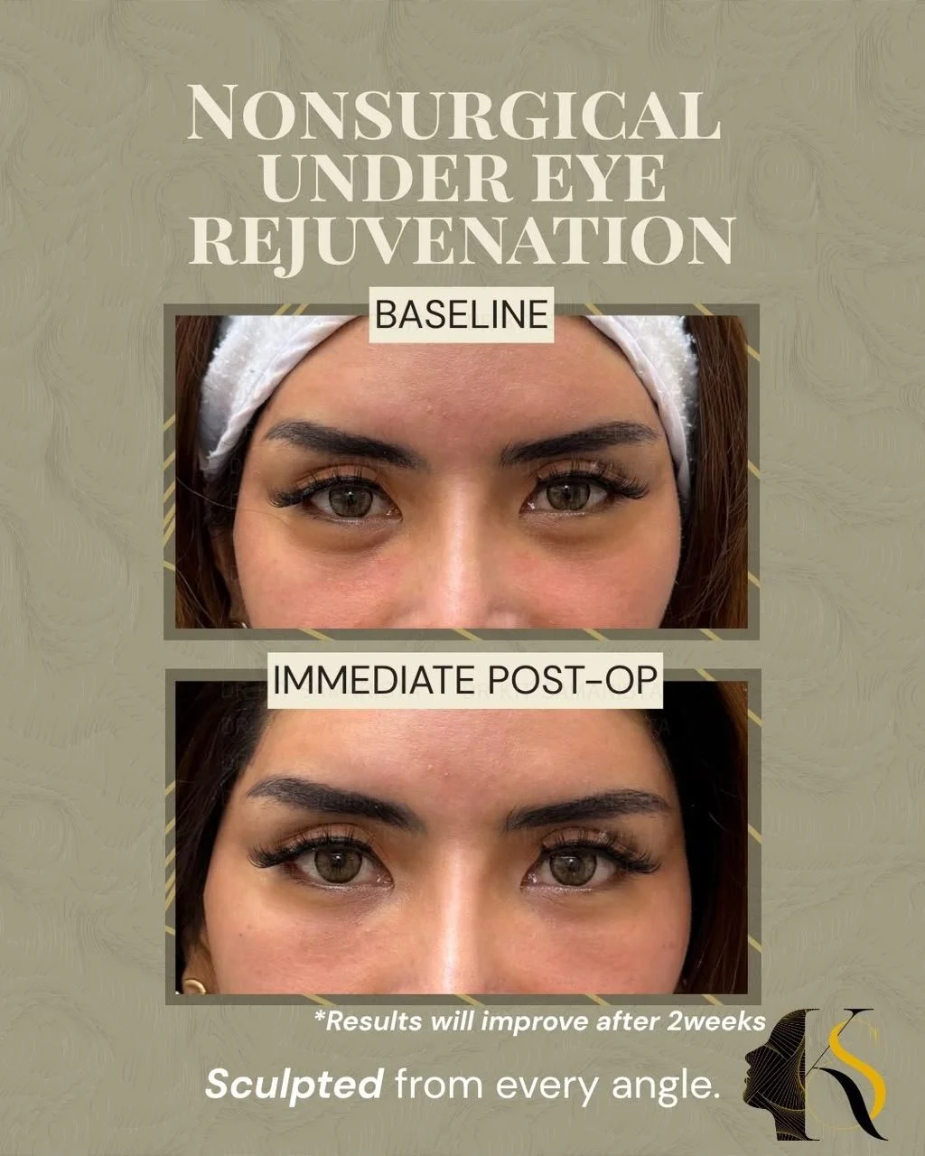 Under eye Rejuvenation 
Your under-eye area is one of the first places to show signs of aging. Instead of simply filling hollows, Collagen Banking works by stimulating your body&rsquo;s natural collagen production to improve skin quality over time.

