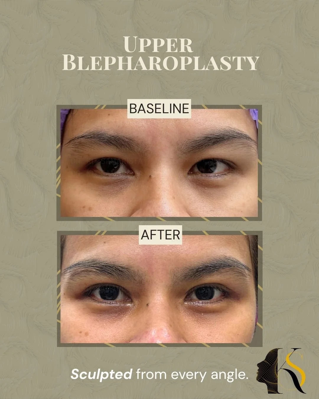 Upper Blepharoplasty | Subtle Change, Brighter Eyes ✨

Sometimes a small change around the eyes can refresh the entire face.

This Upper Blepharoplasty was designed to remove excess upper eyelid skin while preserving a natural-looking crease and the 