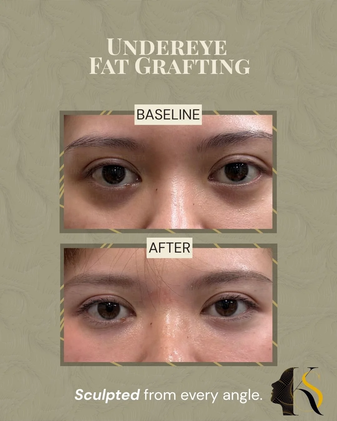Undereye Fat Grafting | Restore, Don&rsquo;t Overfill ✨

Tired-looking eyes aren&rsquo;t always caused by lack of sleep. Sometimes, it&rsquo;s volume loss and hollowing under the eyes creating shadows that make us look more tired.

For this patient, 