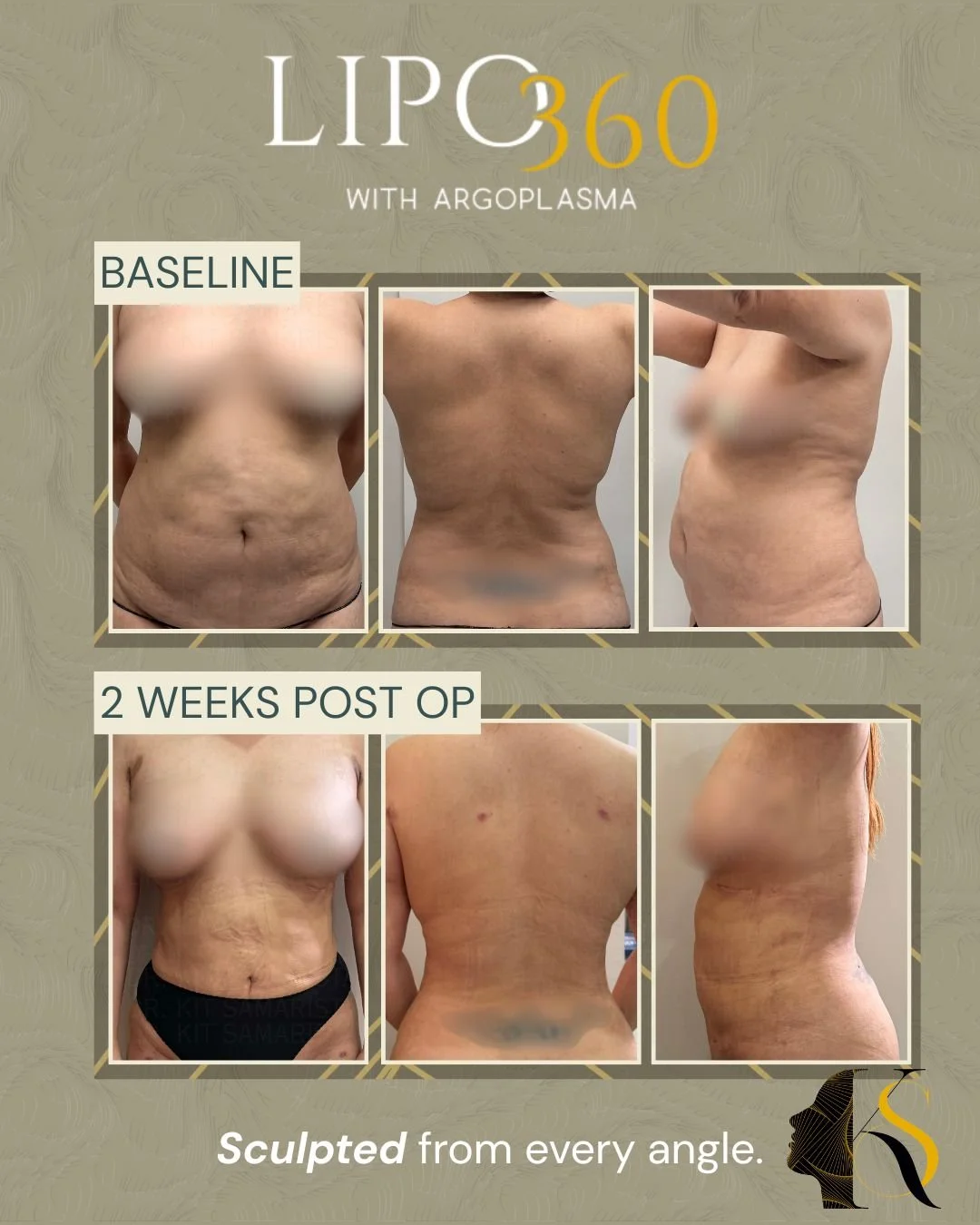 After weight fluctuations, this patient developed excess skin and stubborn areas of fat that affected the overall shape and definition of her figure. Her goal was to achieve a smoother, firmer, and more sculpted silhouette that looked more proportion