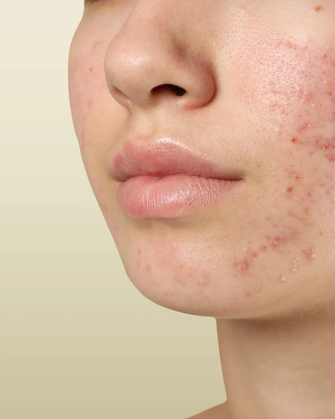 Acne Scar Treatment
