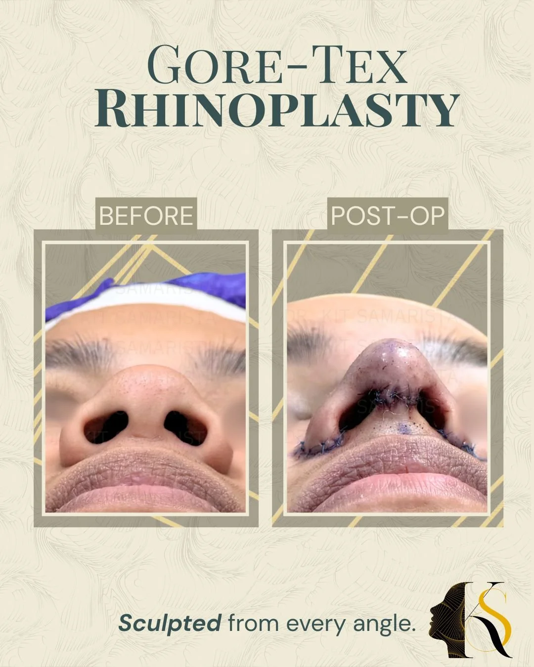 Designed for patients who want refined definition with a softer, more natural feel, Goretex Rhinoplasty offers a balanced approach to nasal enhancement.

Goretex material allows for better tissue integration and smooth contouring, making it a preferr
