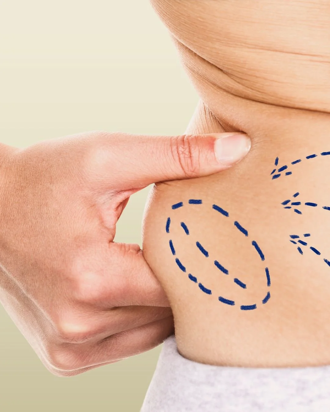 Liposuction