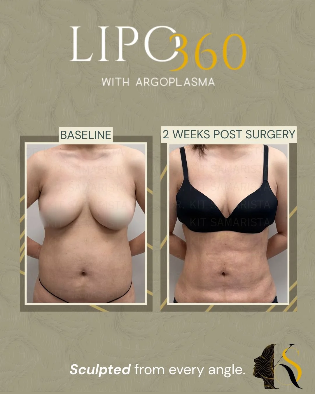 This patient’s main concern was excess fat around the tummy and waist area that made her frame appear heavier and bulkier overall. After undergoing Lipo360, her waistline now appears more defined, her midsection looks flatter, and her overall figure 