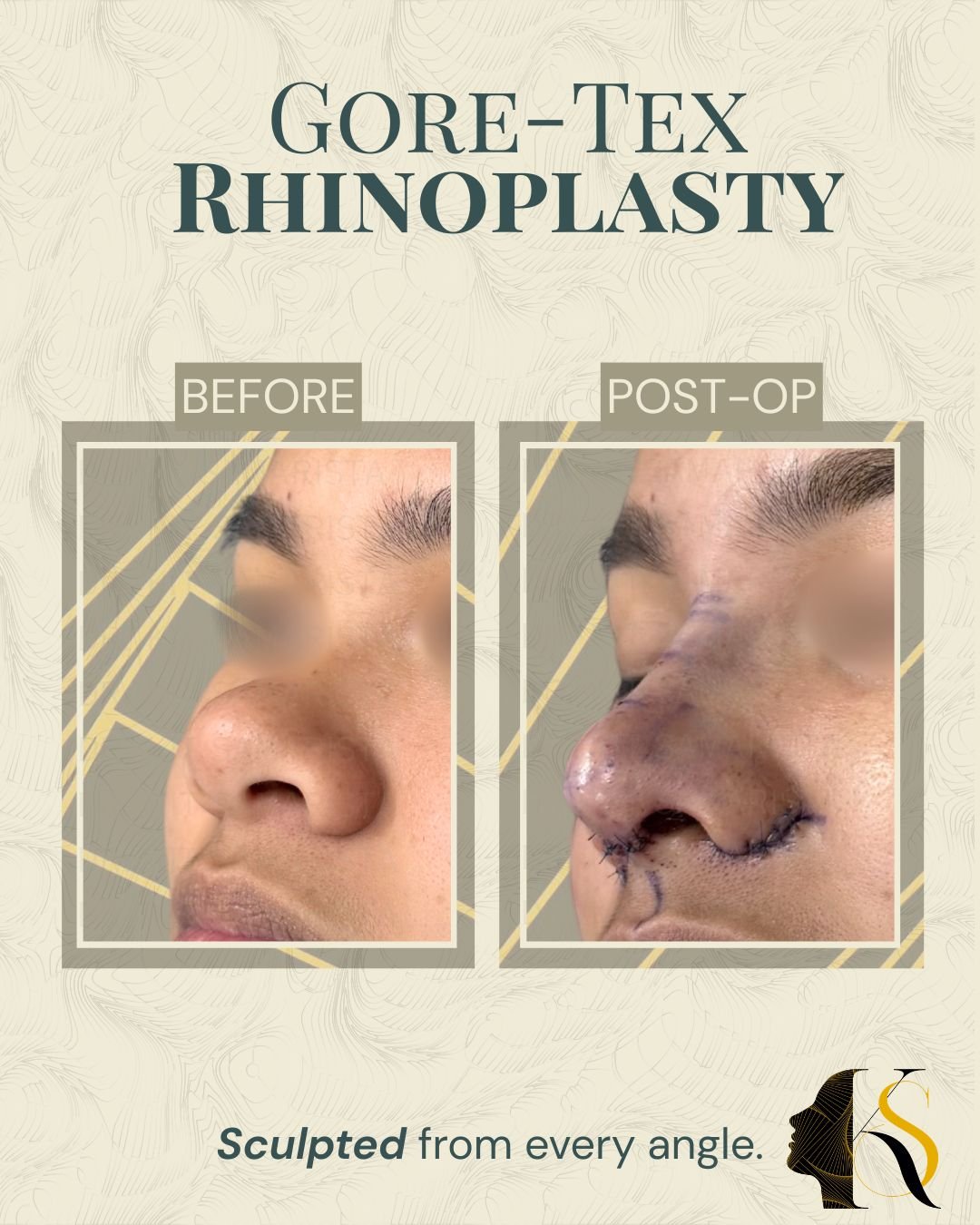 Designed for patients who want refined definition with a softer, more natural feel, Goretex Rhinoplasty offers a balanced approach to nasal enhancement.

Goretex material allows for better tissue integration and smooth contouring, making it a preferr