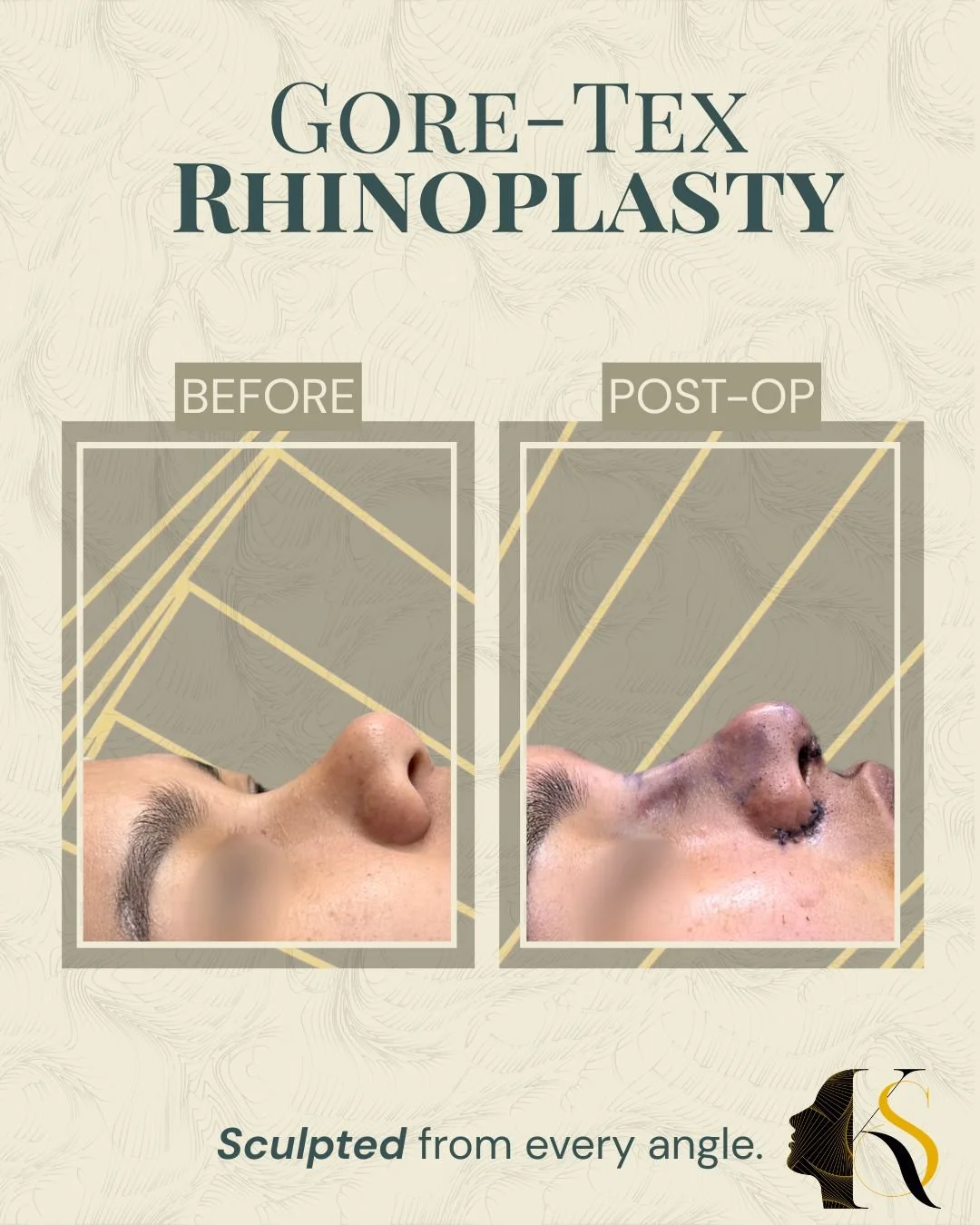 Designed for patients who want refined definition with a softer, more natural feel, Goretex Rhinoplasty offers a balanced approach to nasal enhancement.

Goretex material allows for better tissue integration and smooth contouring, making it a preferr