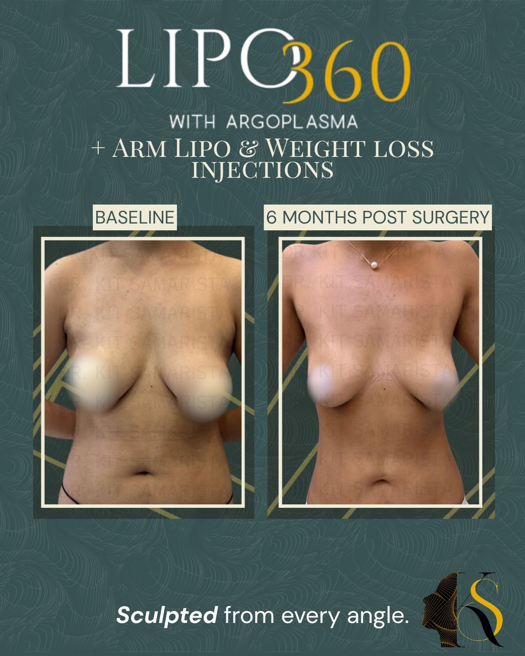 This patient’s goal was to achieve a slimmer, more proportioned figure while targeting stubborn fat in the midsection and arms. Through Lipo360, Arm Liposuction, and guided weight loss injections, she has achieved a more sculpted silhouette with bett