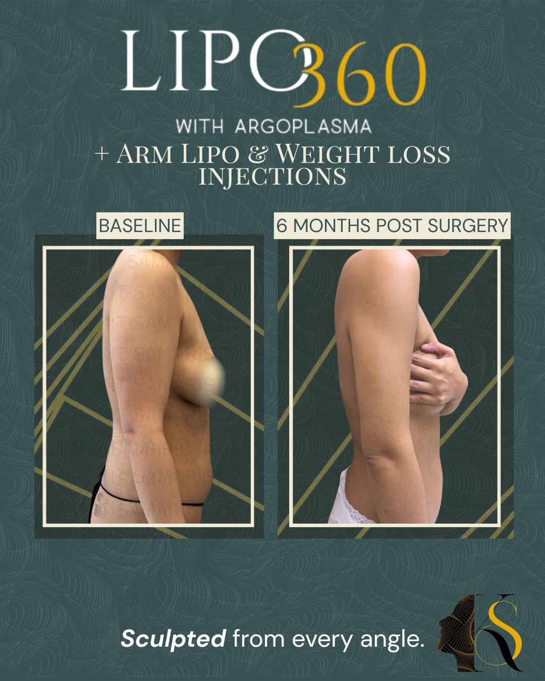 Now at 6 months post-op, the combination of Lipo360, Arm Lipo, and guided weight loss injections helped refine her shape, reduce excess fat, and create a more toned appearance overall. Her arms look slimmer, her waistline is more defined, and her pro