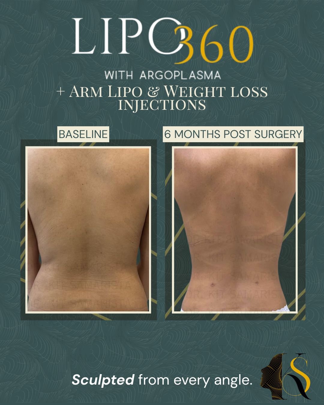 One of the patient’s main concerns was the excess fat around the lower back that made her frame appear heavier and less defined. Through Lipo360, Arm Liposuction, and guided weight loss injections, her silhouette now looks slimmer, smoother, and more