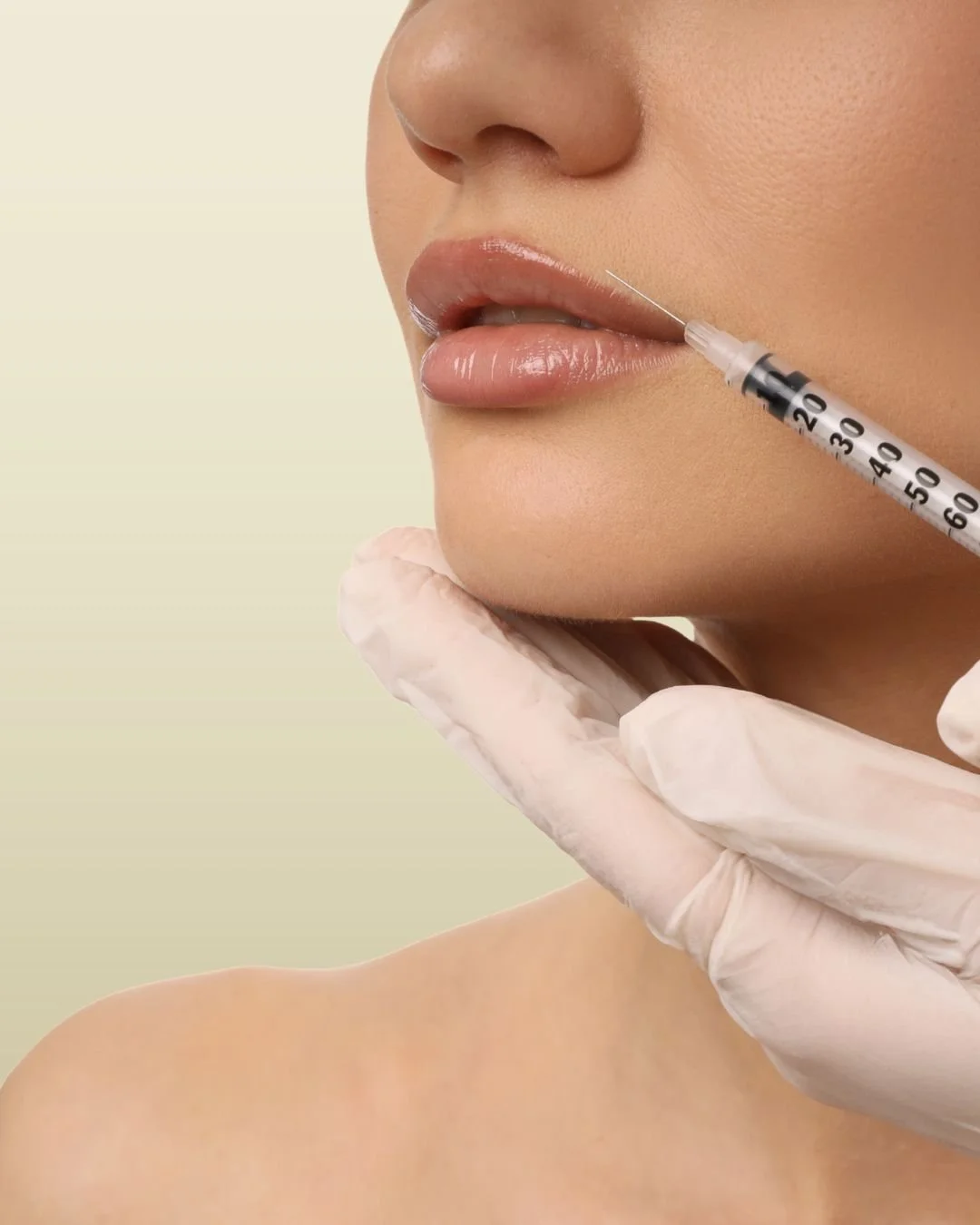 HA Filler Injection