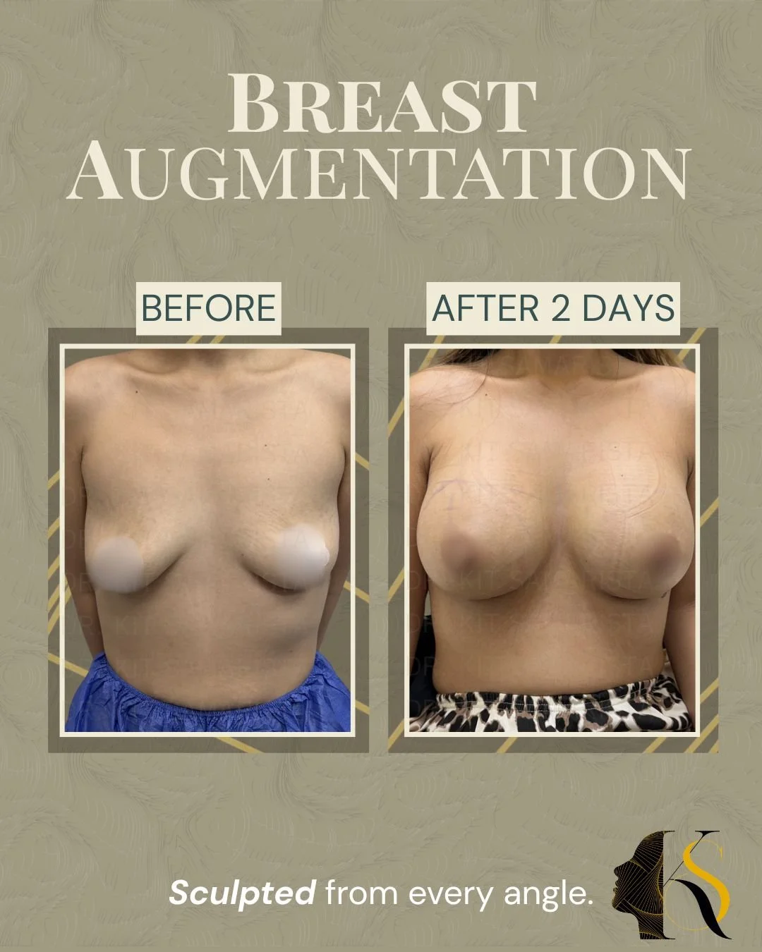 Every procedure is carefully planned according to the patient’s anatomy, frame, and desired outcome. Implant size, profile, and proportions are selected to create results that feel balanced and aligned with the patient’s vision.

Whether the goal is 