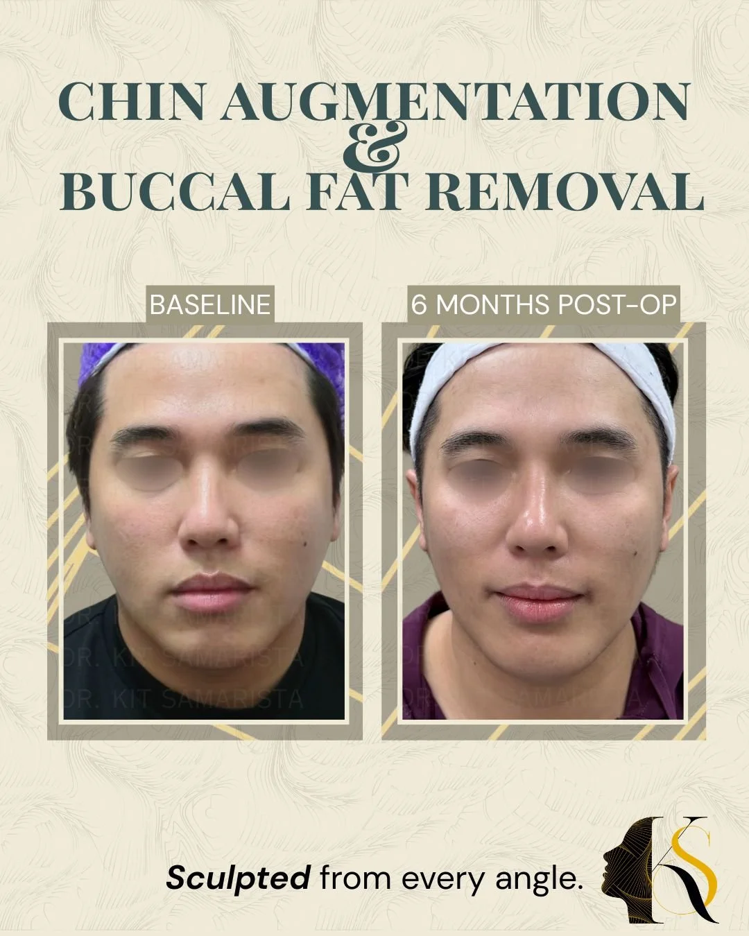 Each procedure enhances a different area of facial contouring. Chin augmentation improves facial balance and projection, buccal fat removal softens cheek heaviness, and double chin liposuction helps define the jaw and neck area for a cleaner profile.