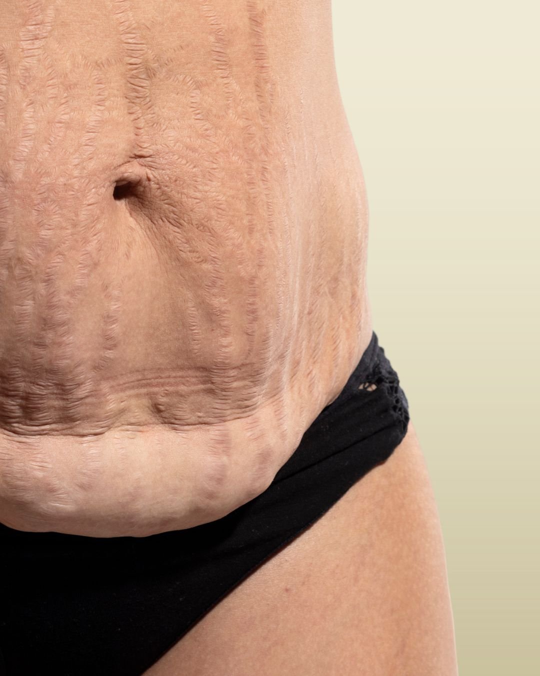 Tummy  Tuck/Abdominoplasty