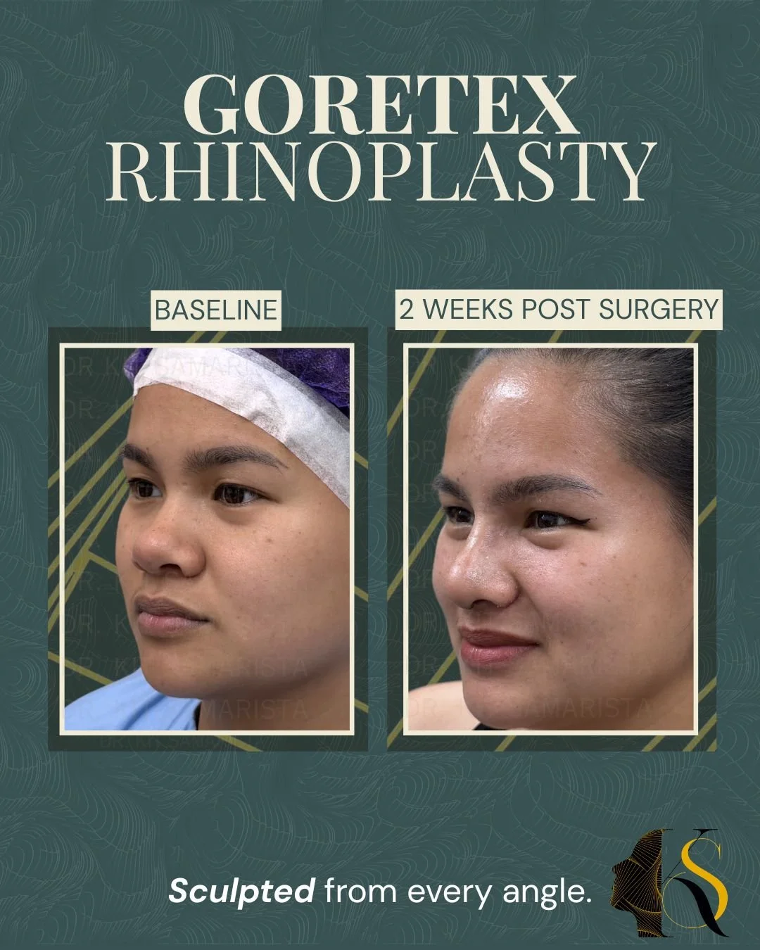 Designed for patients who want refined definition with a softer, more natural feel, Goretex Rhinoplasty offers a balanced approach to nasal enhancement.

Goretex material allows for better tissue integration and smooth contouring, making it a preferr