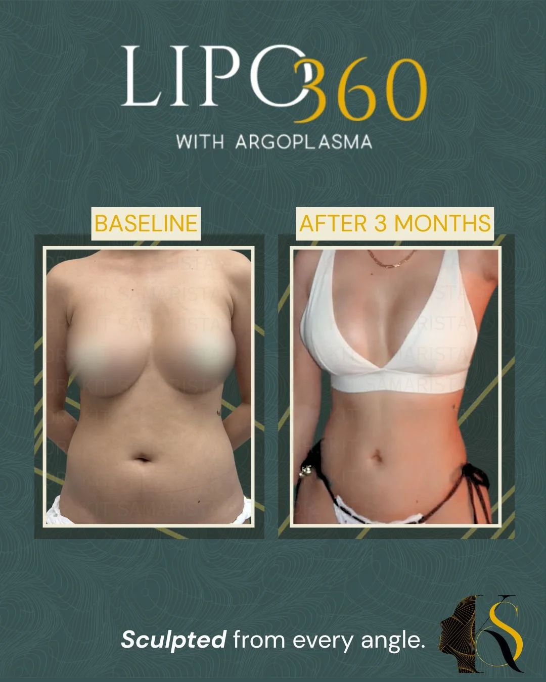 This patient wanted a slimmer, more petite silhouette with better overall proportions. After undergoing Lipo360, the difference is visible in the way her waistline appears more defined, her figure looks leaner, and her body shape feels more balanced 