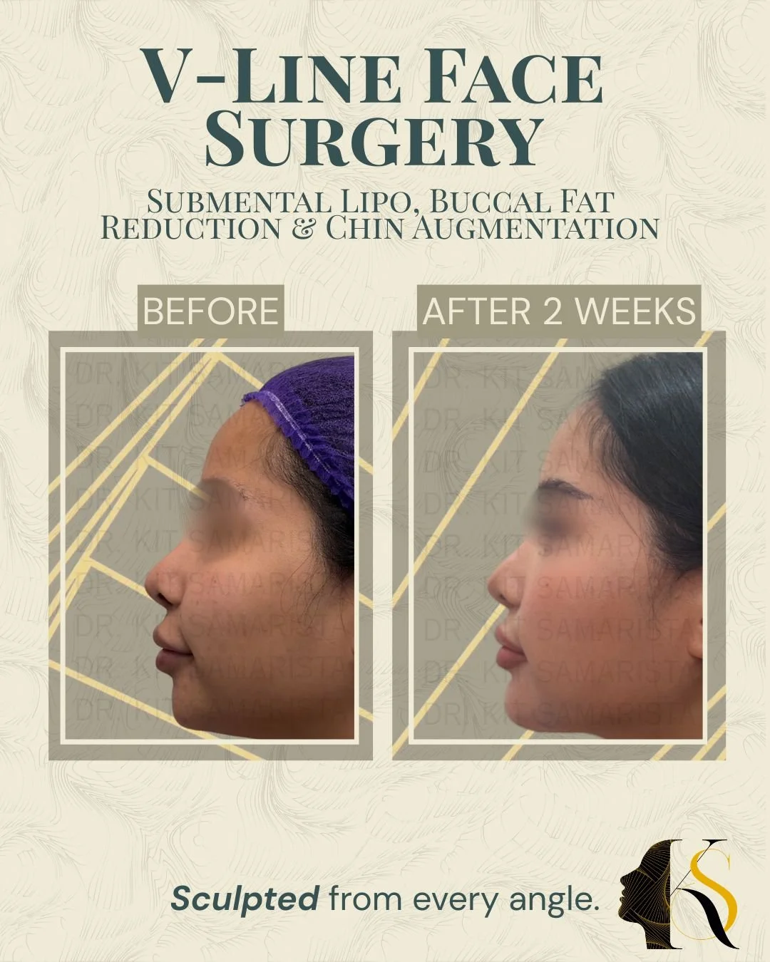 Each procedure enhances a different area of facial contouring. Chin augmentation improves facial balance and projection, buccal fat removal softens cheek heaviness, and double chin liposuction helps define the jaw and neck area for a cleaner profile.