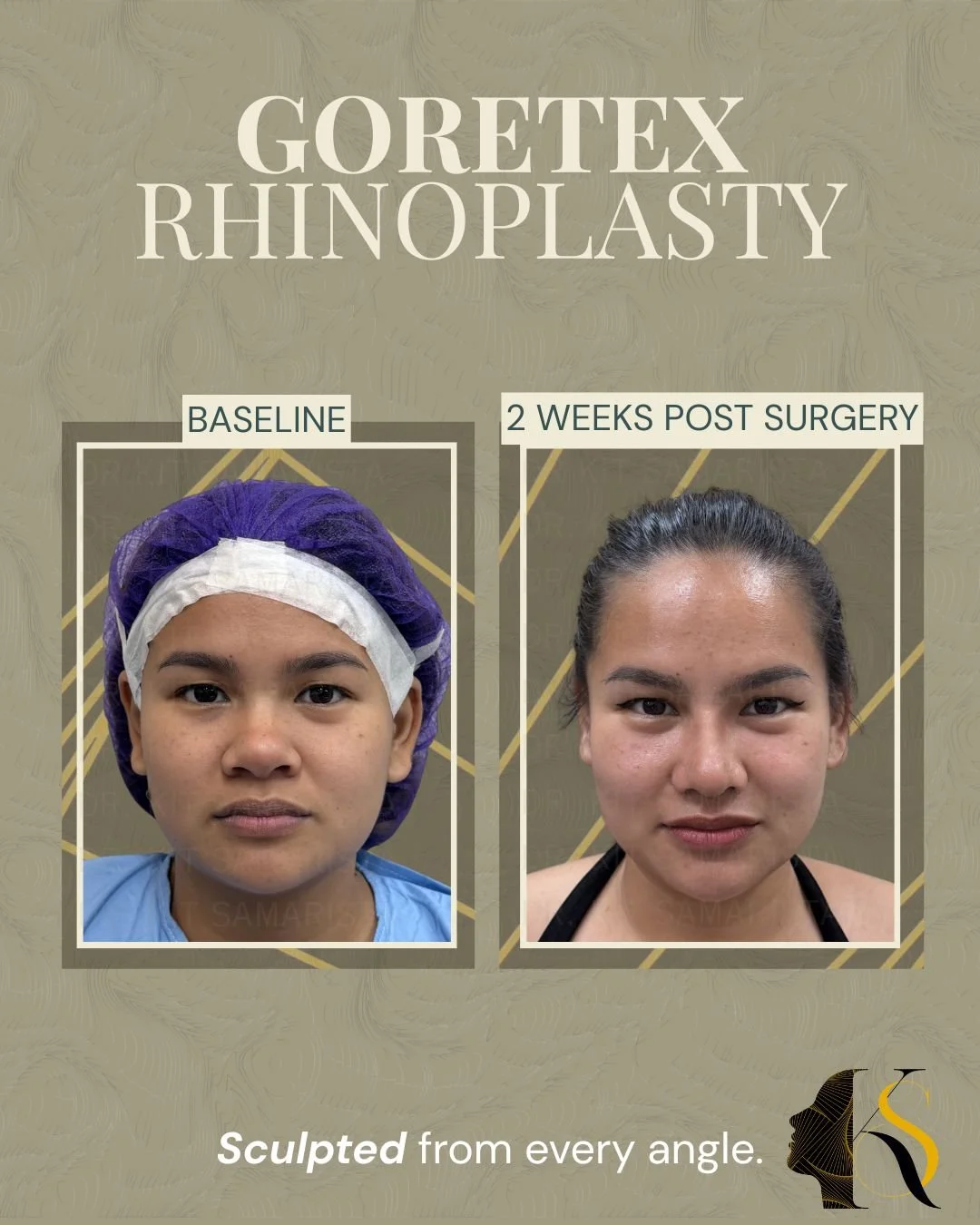 Designed for patients who want refined definition with a softer, more natural feel, Goretex Rhinoplasty offers a balanced approach to nasal enhancement.

Goretex material allows for better tissue integration and smooth contouring, making it a preferr