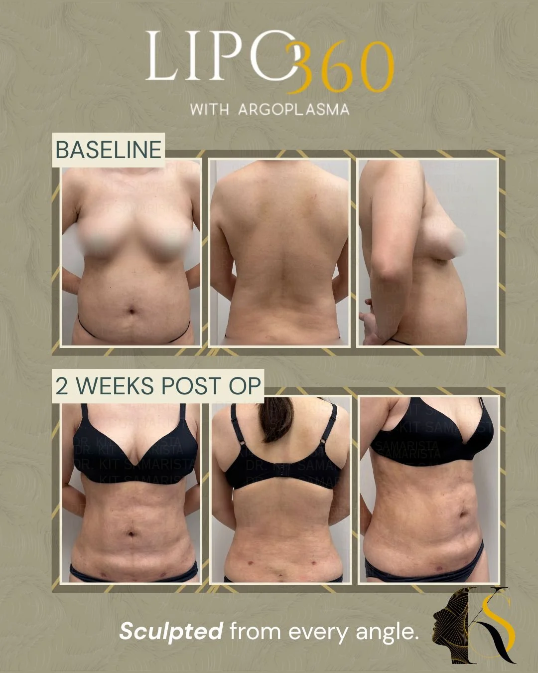 Lipo360+Argoplasma px E.jpg