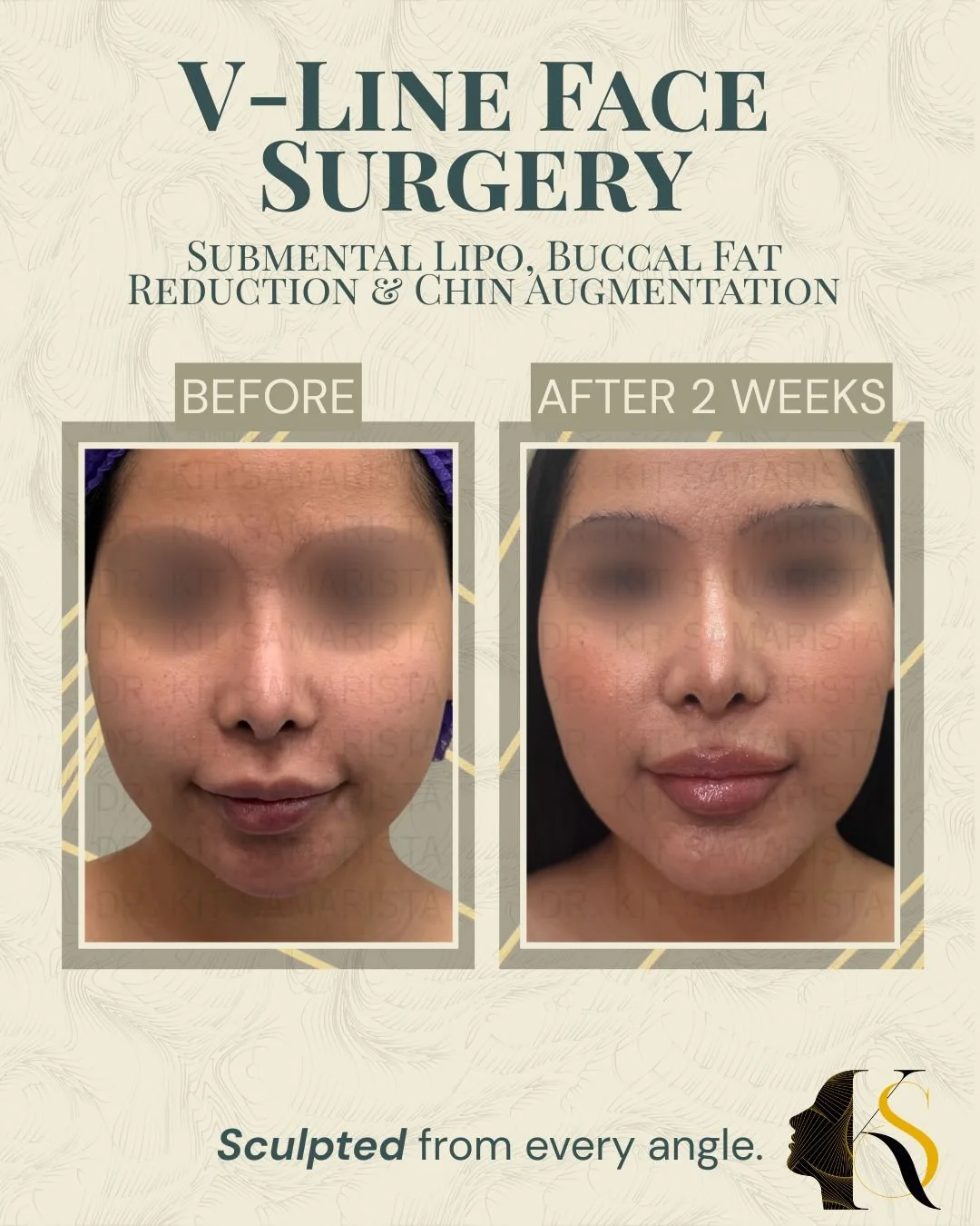 Each procedure enhances a different area of facial contouring. Chin augmentation improves facial balance and projection, buccal fat removal softens cheek heaviness, and double chin liposuction helps define the jaw and neck area for a cleaner profile.