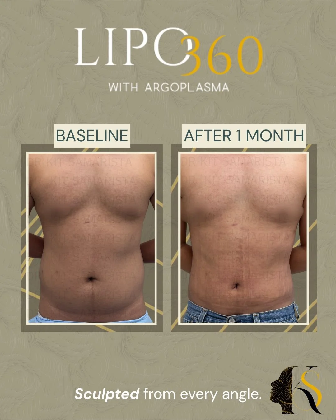 This patient's goal was to remove stubborn fat that softened his natural muscle definition and made his frame appear less toned. Through body contouring, we were able to create a leaner, firmer appearance that allows his chest, abdomen, and overall s