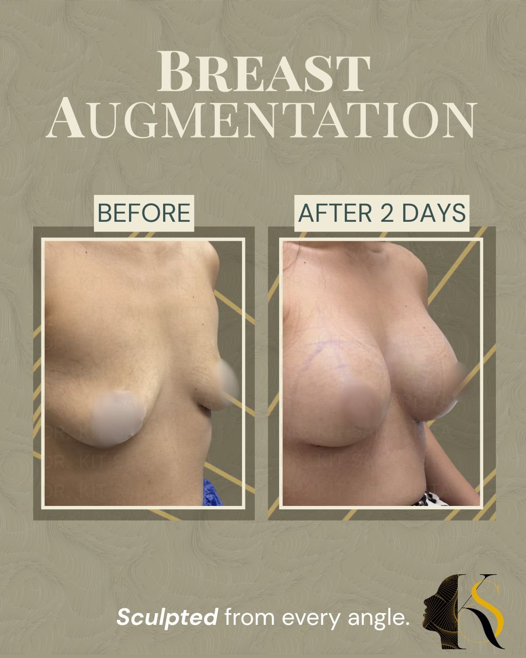 Every procedure is carefully planned according to the patient’s anatomy, frame, and desired outcome. Implant size, profile, and proportions are selected to create results that feel balanced and aligned with the patient’s vision.

Whether the goal is 