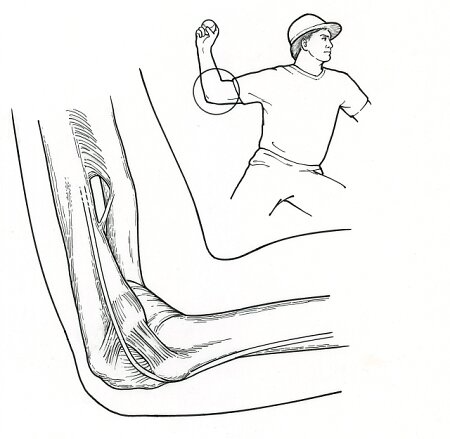 Tips for Successful Ulnar Collateral Ligament Reconstruction