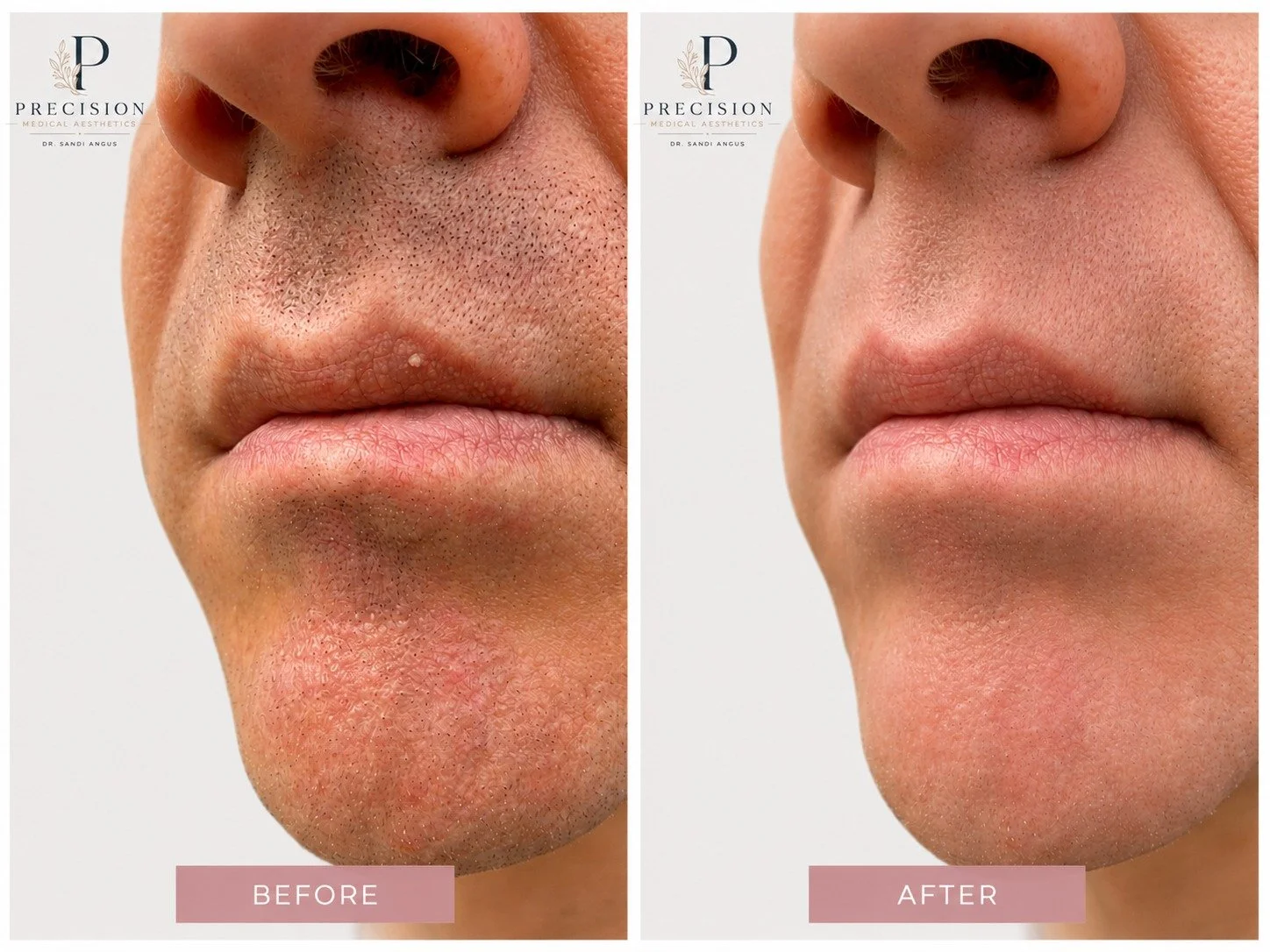 Sometimes it's the smallest things that affect our confidence the most.

This client had a tiny milia on the border of the upper lip that had been bothering them for some time. Although medically harmless, it had become something they noticed every t