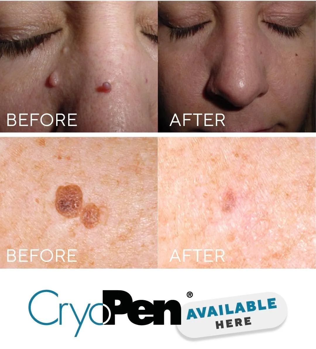 Summer is a time for holidays, weddings, family photos and spending more time outdoors&mdash;not worrying about that skin lesion you&rsquo;ve been meaning to have looked at.

Many benign skin lesions such as skin tags, seborrhoeic keratoses, age spot