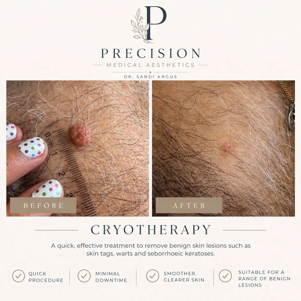 ✨ Cryotherapy results ✨

What a great result for this troublesome little lesion!

Although completely benign, it had become a real nuisance for this patient because it was raised and repeatedly catching on clothing. Following cryotherapy, it has heal