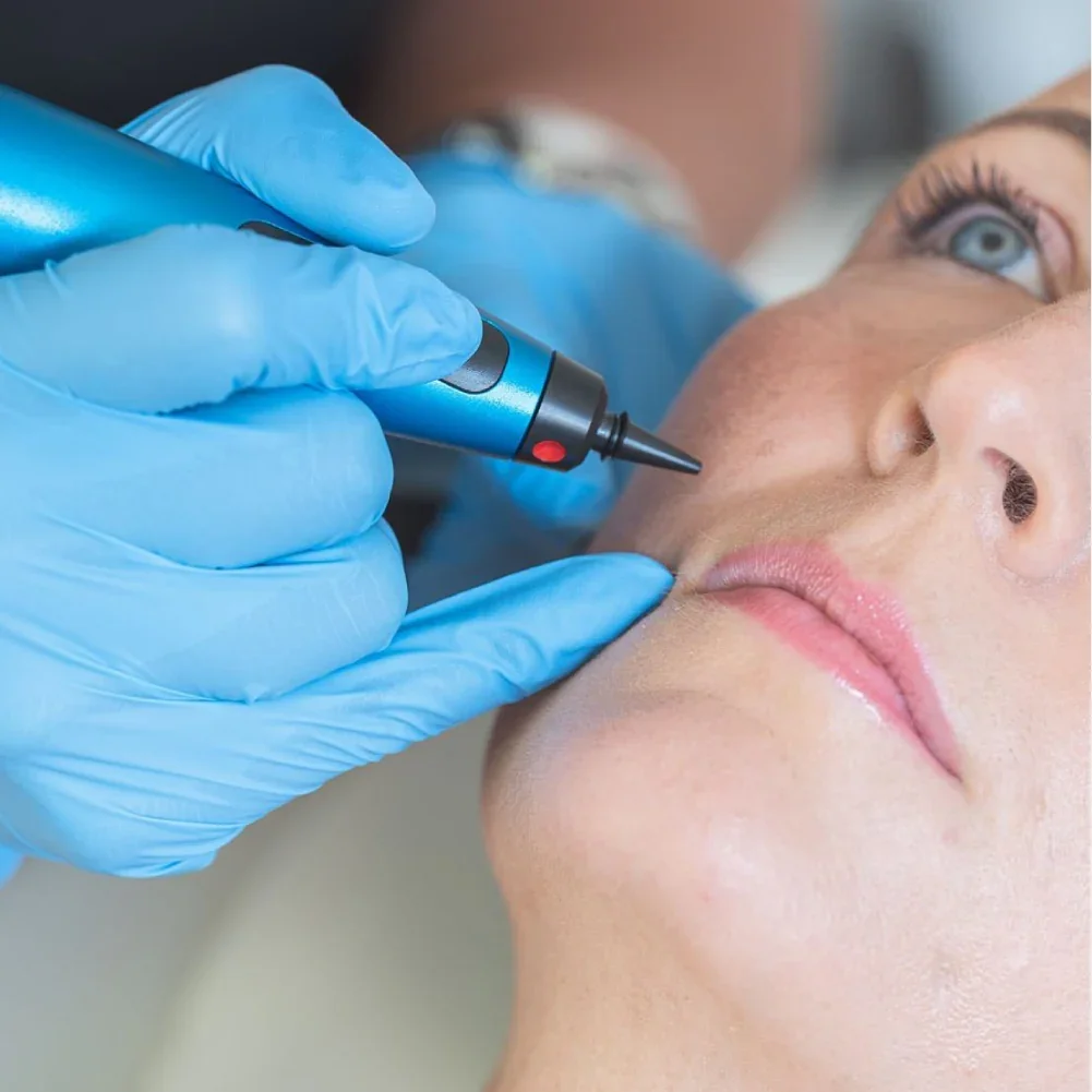 A woman receiving a cosmetic or dermatological treatment with a pen-like device on her cheek, wearing gloves and looking upwards.