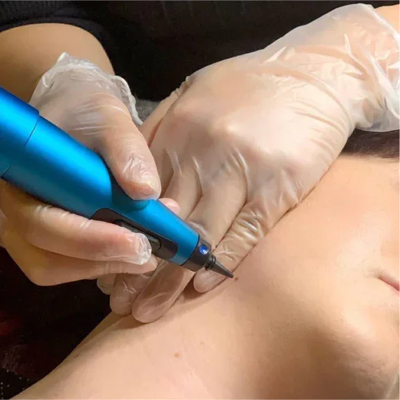 A person receiving a cryotherapy skin lesion removal procedure on the neck area from a technician wearing gloves.