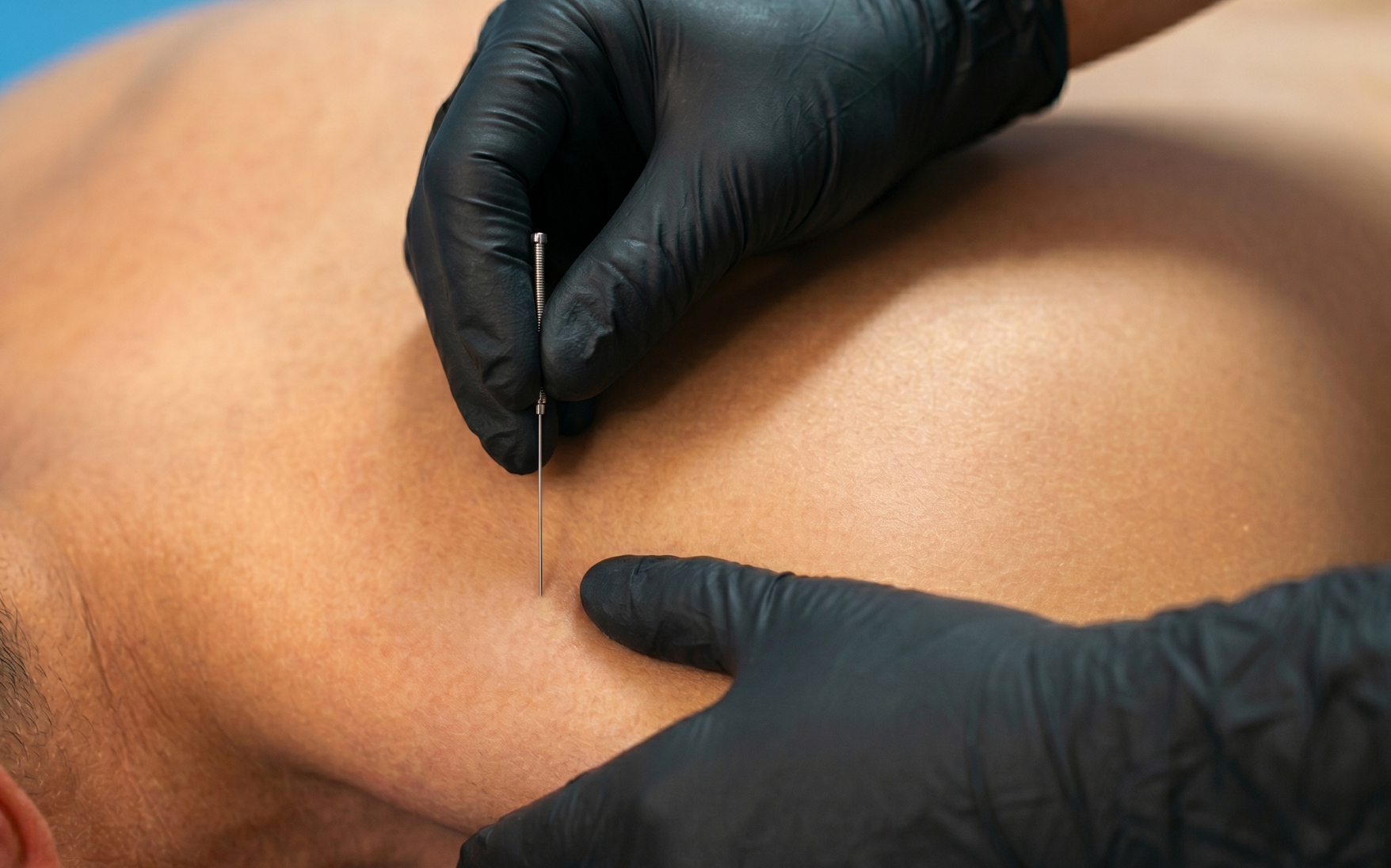Registered physiotherapist performing intramuscular stimulation (IMS) dry needling (biomedical dry needling) in a private treatment room at Northstar Physiotherapy in Cambrian Heights.