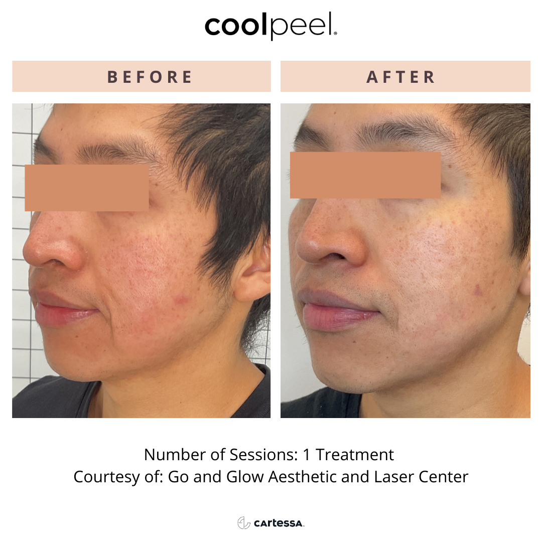 Side-by-side comparison of a man's face before and after skincare treatment showing reduced acne scars and smoother skin. Label at top: 'cool peel', 'BEFORE' and 'AFTER'. Caption below: 'Number of Sessions: 1 Treatment Courtesy of: Go and Glow Aesthetic and Laser Center' and 'CARTESSA'.