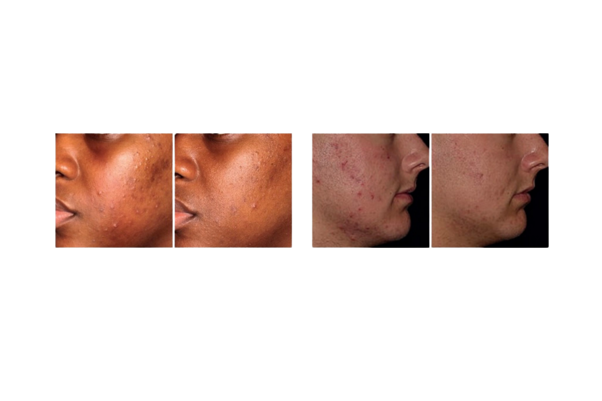 Before and after images of a person's face showing improvement in skin conditions, with noticeable reduction of acne scars and blemishes.