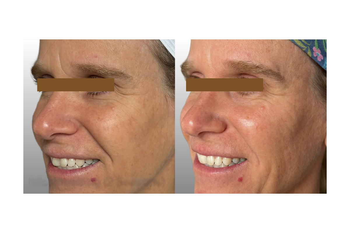 Side-by-side comparison of a man's face before and after skincare treatment, showing improved skin texture and reduced wrinkles.