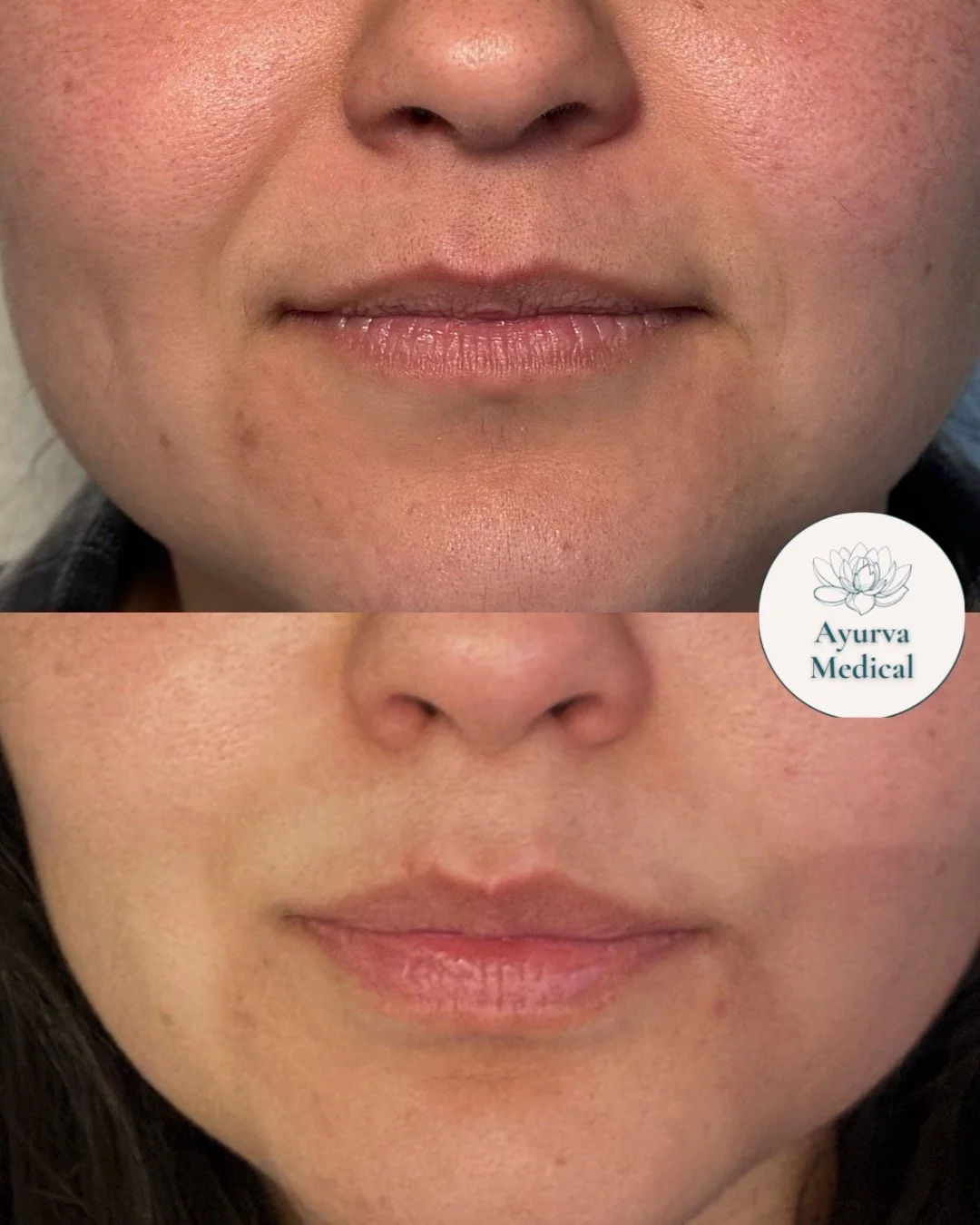Close-up before and after comparison of a person's lower face, showing skin improvements. The 'after' image shows clearer skin with reduced blemishes.