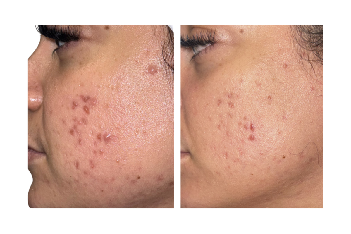 Comparison of a woman's cheek showing acne before and after treatment, with clearer skin on the right.