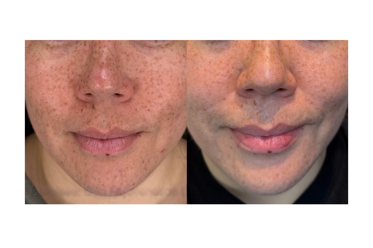 Side-by-side comparison of a woman's face before and after skin treatment, showing reduced freckles and smoother skin on the right.