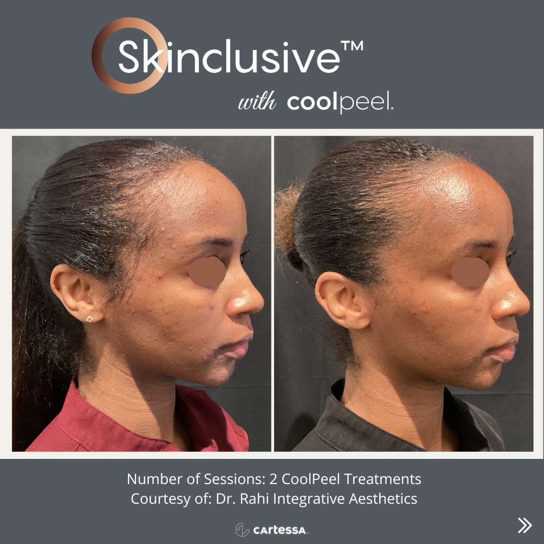 Before and after comparison of a woman's face showing improvement in skin texture and clarity after two CoolPeel treatments, courtesy of Dr. Rahi Integrative Aesthetics.