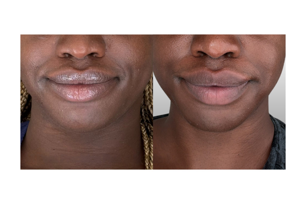 Close-up of a woman's face showing a before and after comparison of her lips.