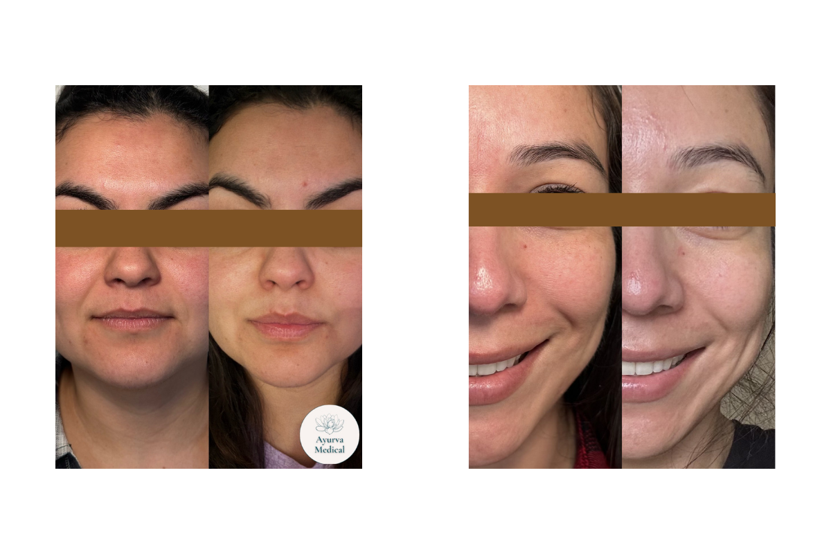 Before and after comparison of a woman's face, showing skin improvements, with close-up of the forehead, cheeks, and smile area.