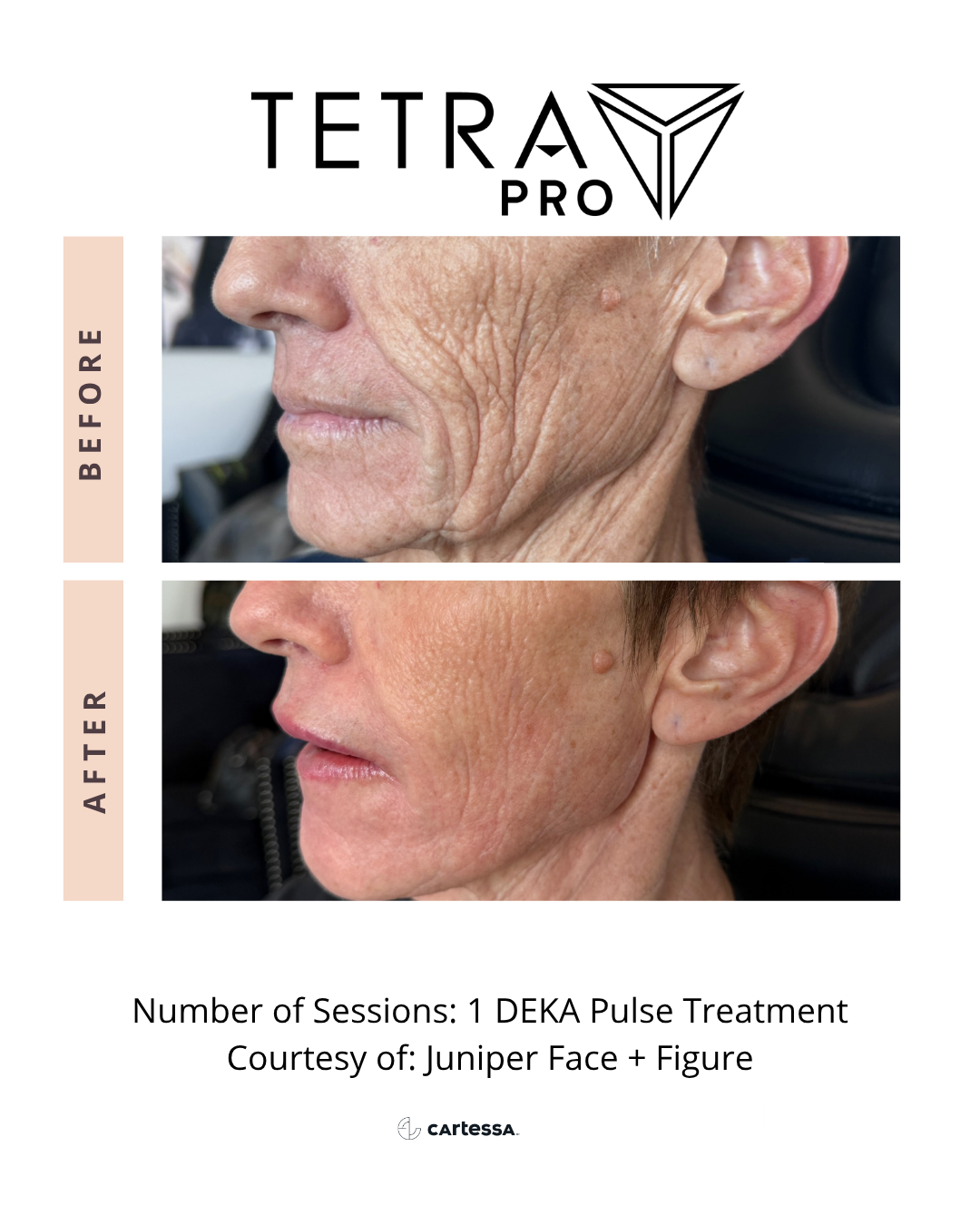 Side-by-side comparison of a woman's face before and after one DEKA Pulse treatment, showing smoother and less wrinkled skin.