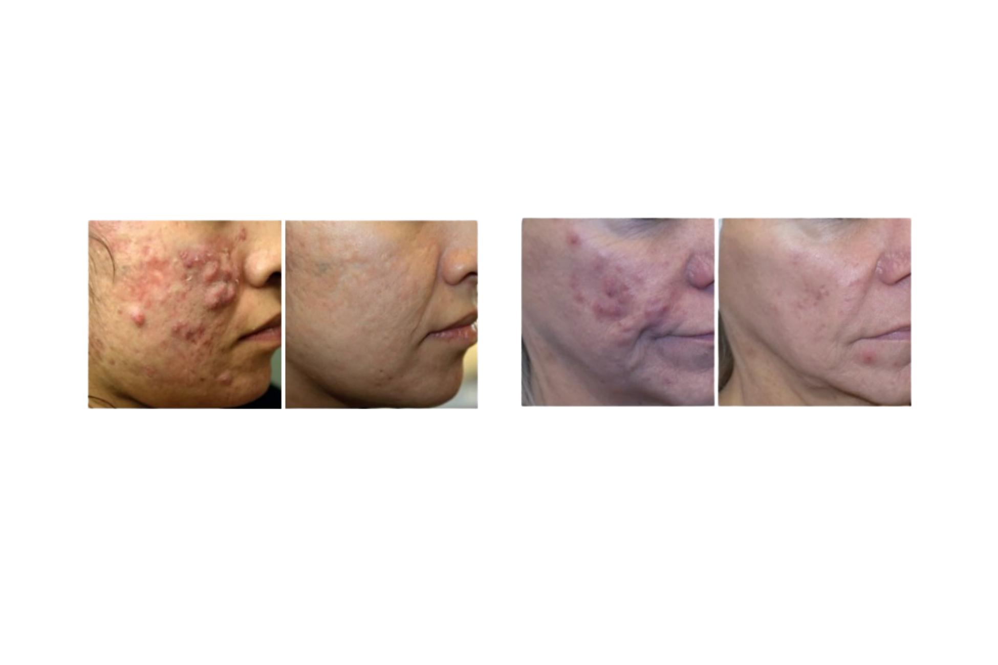Progression of skin treatment showing clear improvements in acne scars and skin texture over four stages.