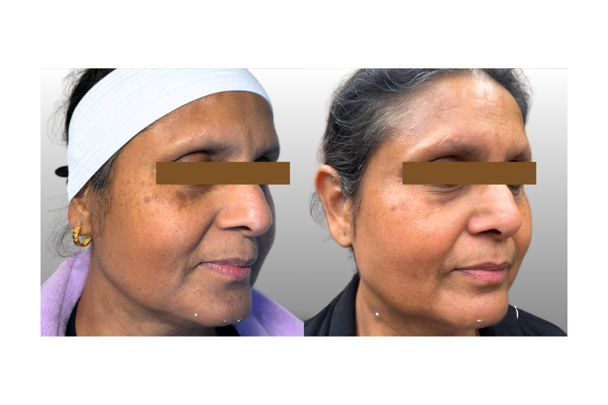 Side-by-side comparison of a woman's face showing before and after skin treatment, with visible improvement in skin clarity and texture.
