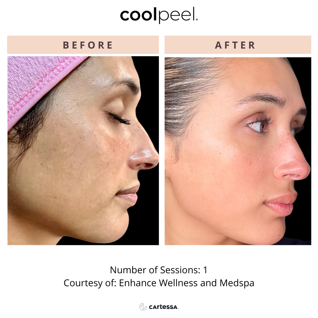 Side-by-side comparison of a woman's face before and after a skincare treatment, showing clear, smooth skin post-treatment with improved texture and complexion.
