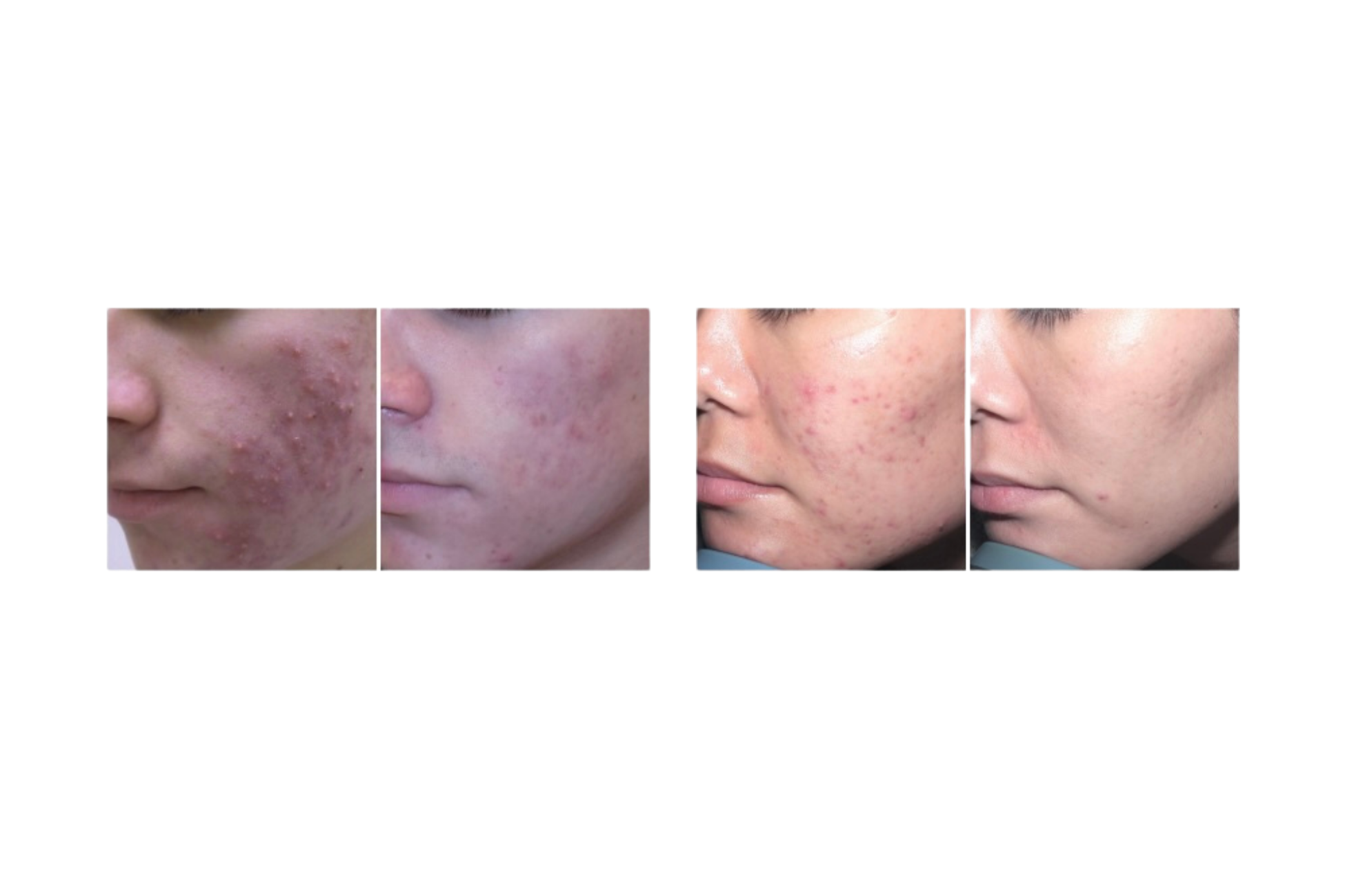 Comparison of skin conditions before and after treatment, showing reduction in acne and scarring.