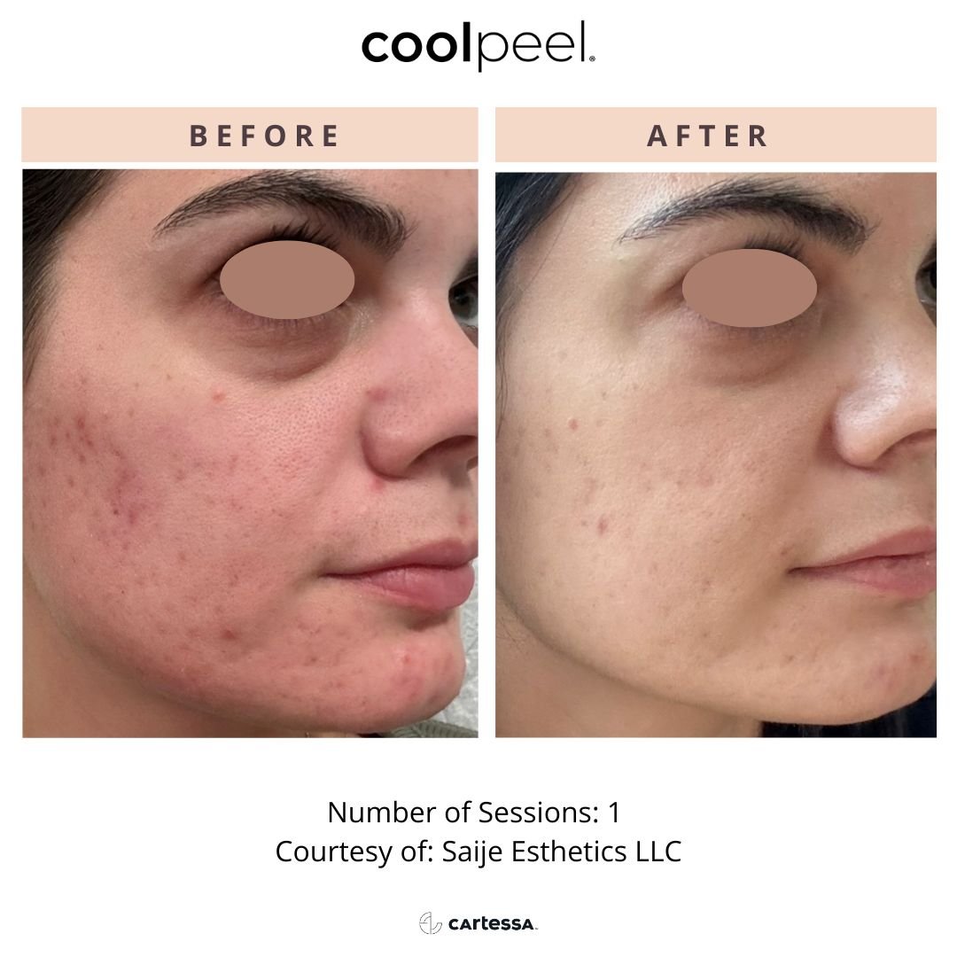 Before and after images of a woman's face showing improved skin condition after one skincare treatment, with visible reduction in acne and blemishes.